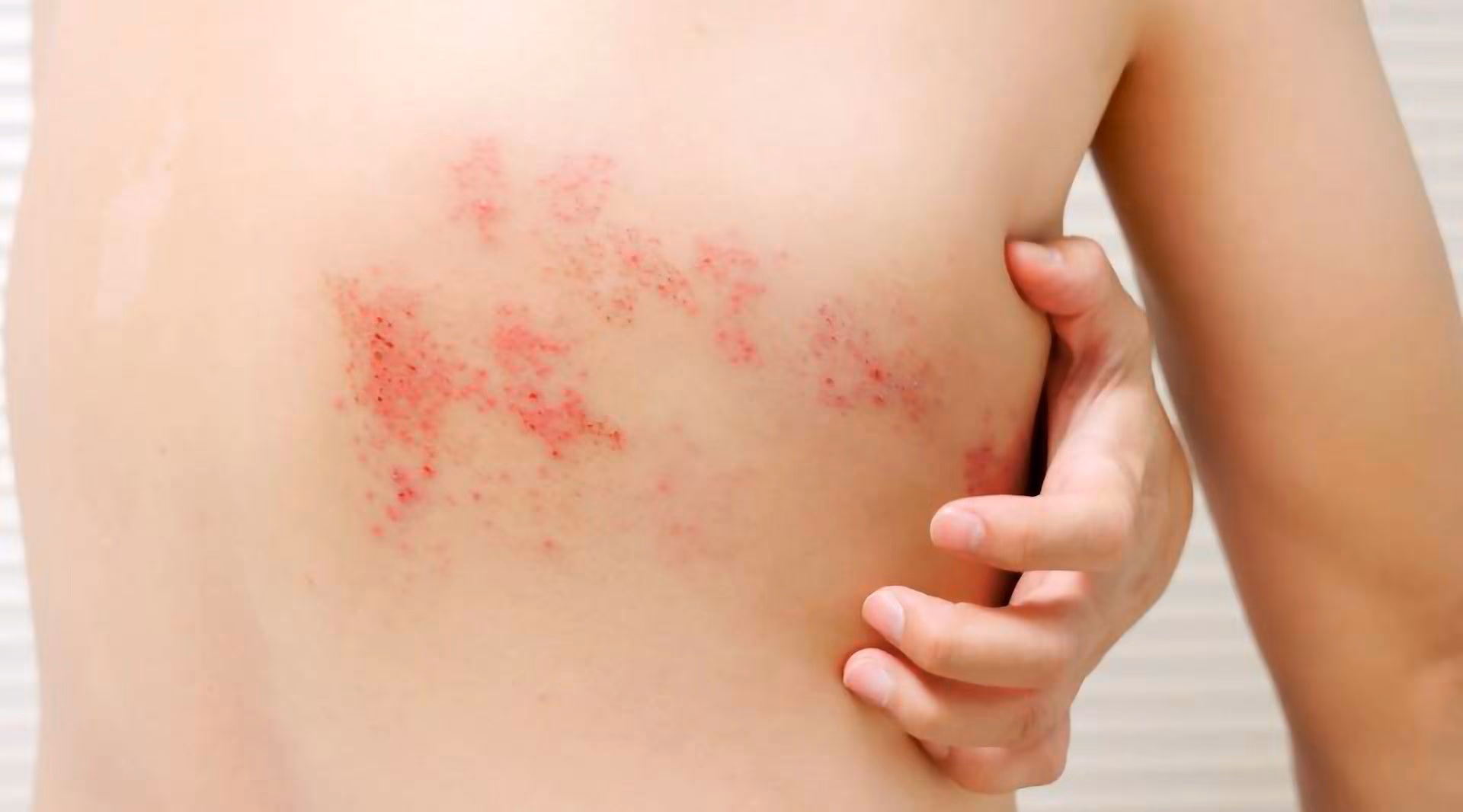 ¿El herpes zóster está contraindicado en la acupuntura?