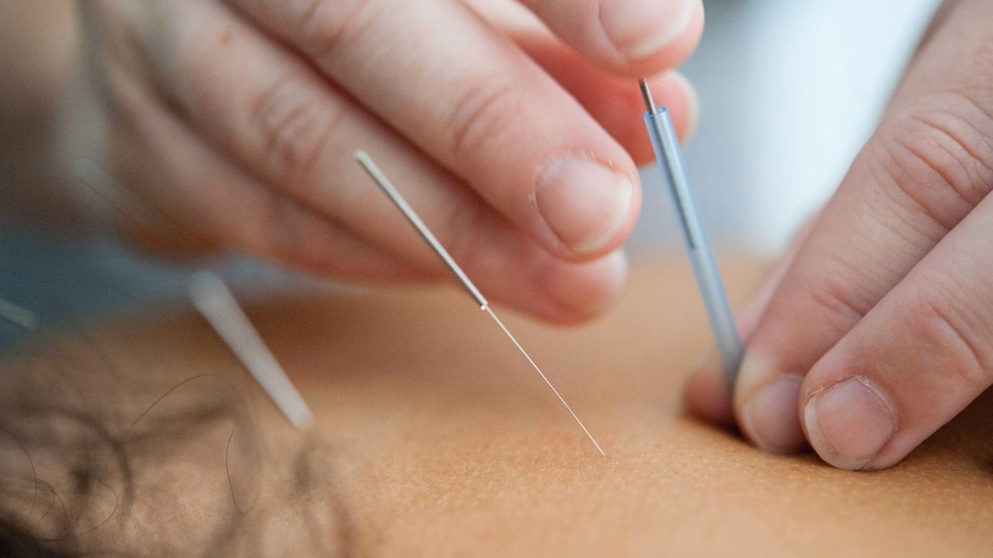 ¿Qué tan efectivos son los hilos de colágeno?