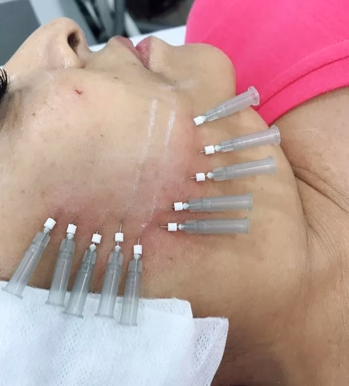 ¿Cuánto cuesta ponerse hilos de colágeno?