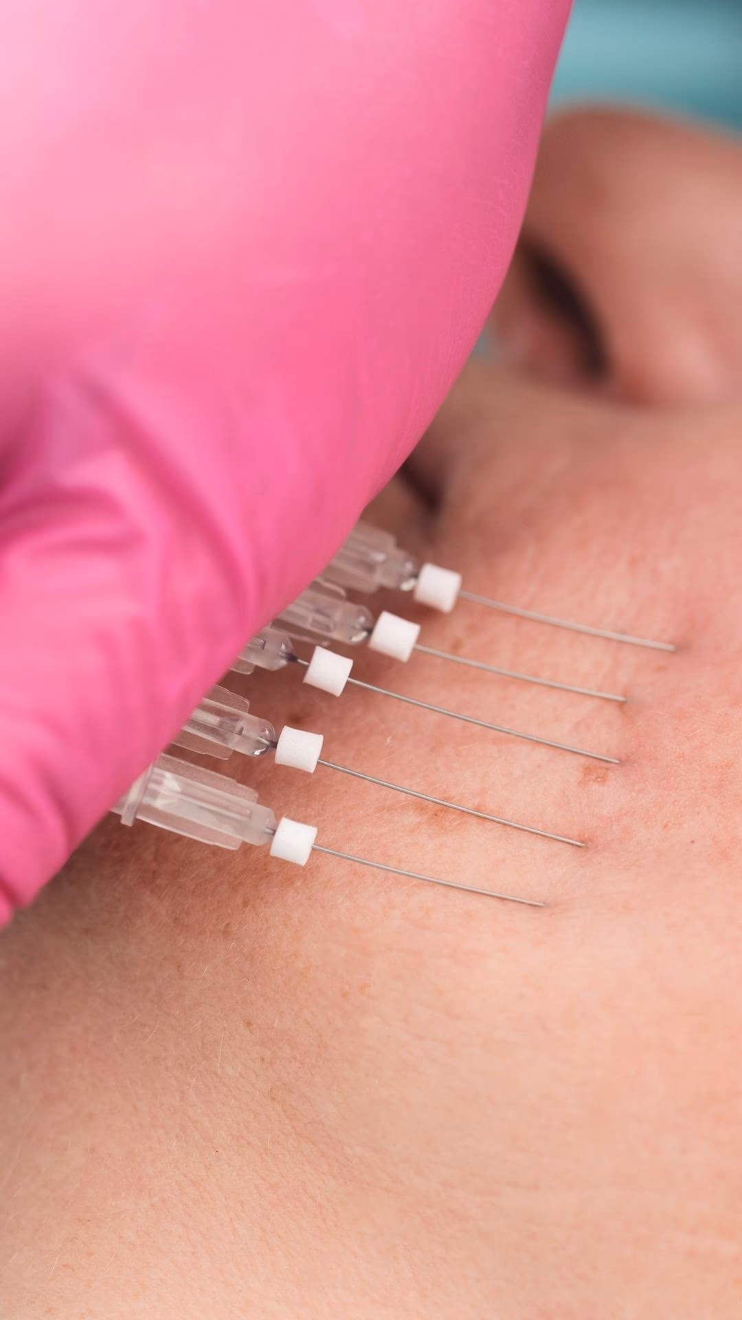 ¿Qué tan efectivos son los hilos de colágeno?