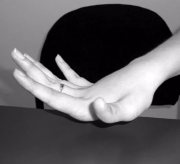 ¿Qué doctor trata la hiperlaxitud?