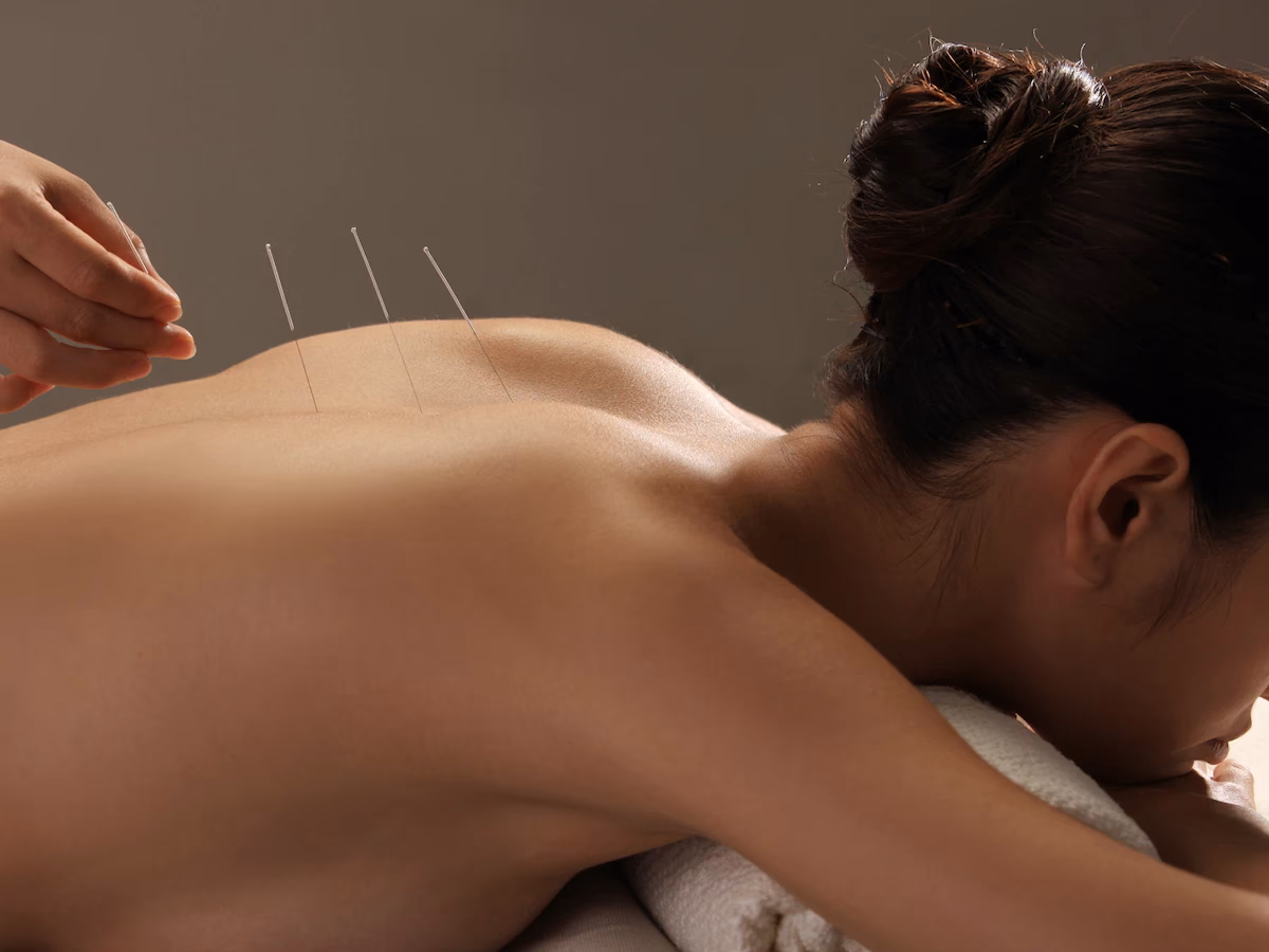 ¿La acupuntura es un cuidado paliativo?