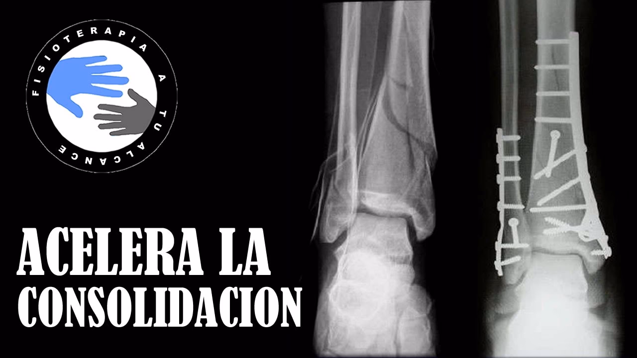 ¿Qué es bueno para soldar un hueso roto?