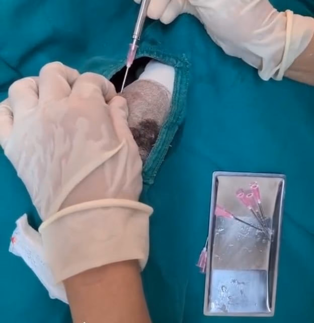 What is embedding for weight loss?