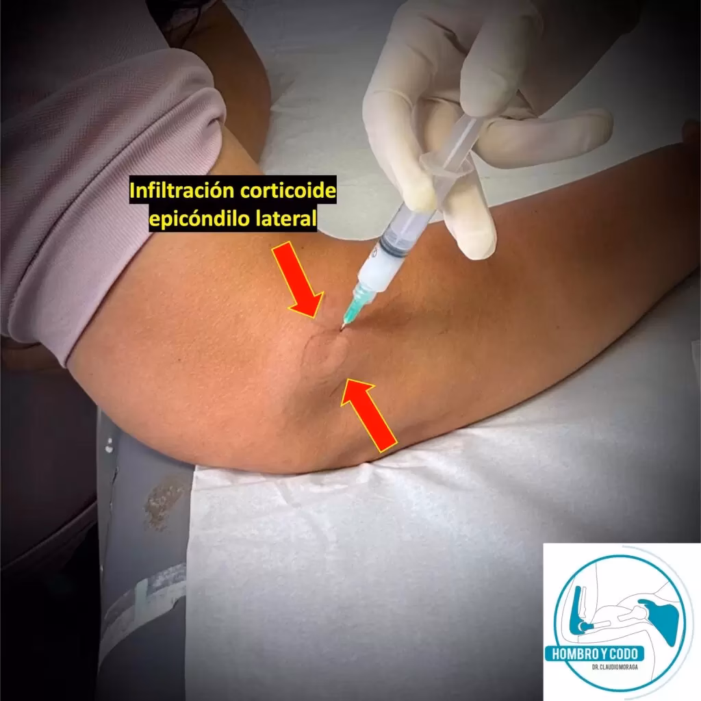 ¿Cuál es la mejor inyección para el codo de tenista?
