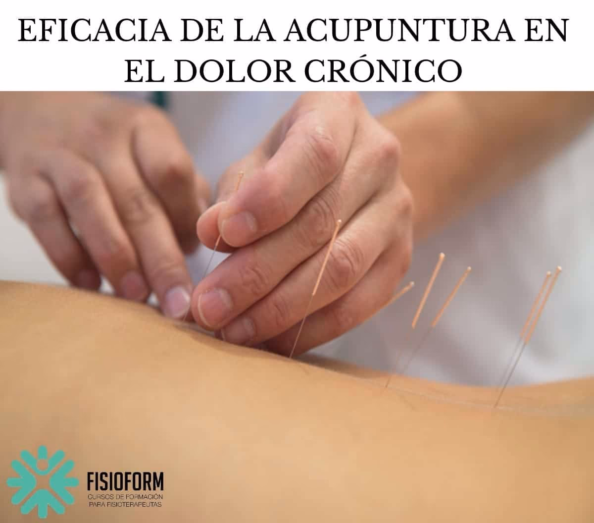 ¿Puede la acupuntura ayudar con la espondiloartritis?