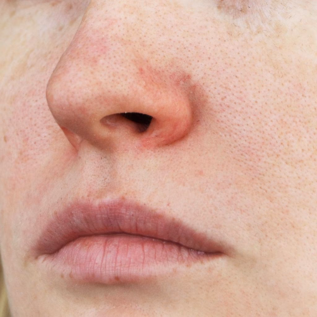 ¿Qué origen emocional tiene la rosácea?