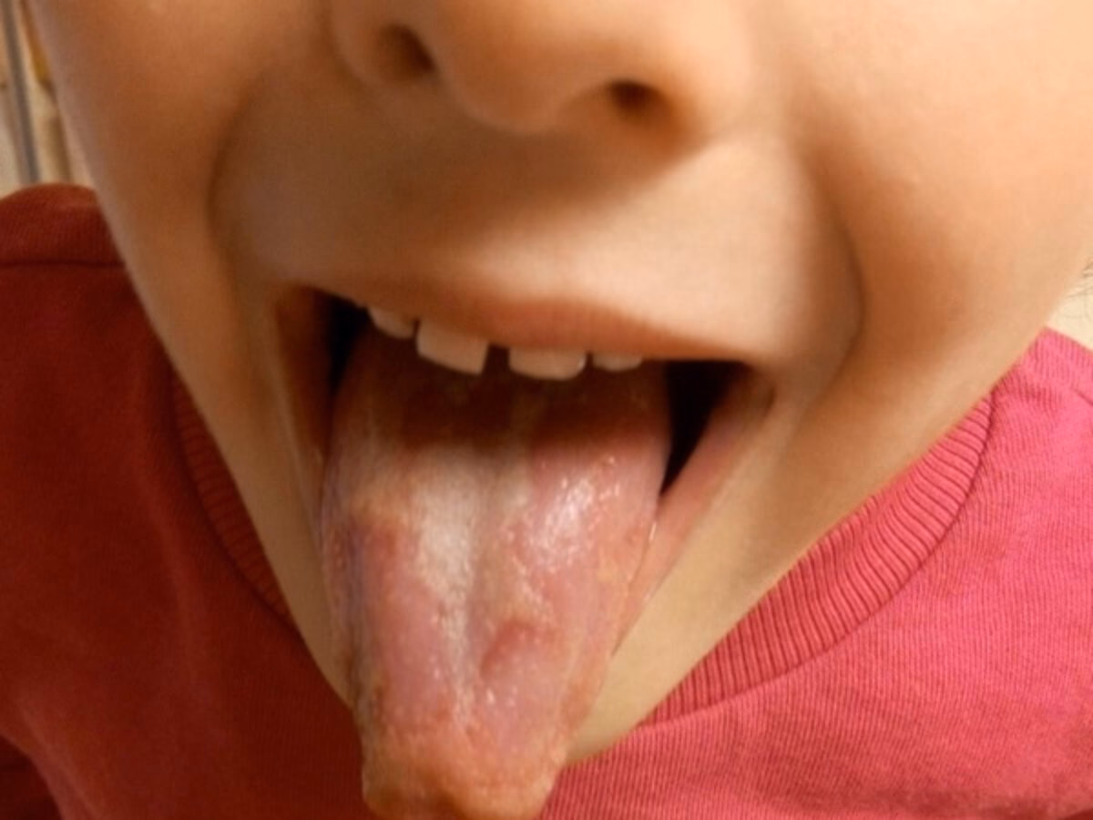 ¿Qué significa tener la lengua con ondulaciones a los lados?