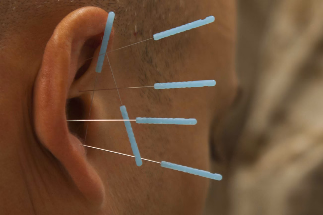 ¿Cuánto cuesta renovar su licencia de acupuntura en California?