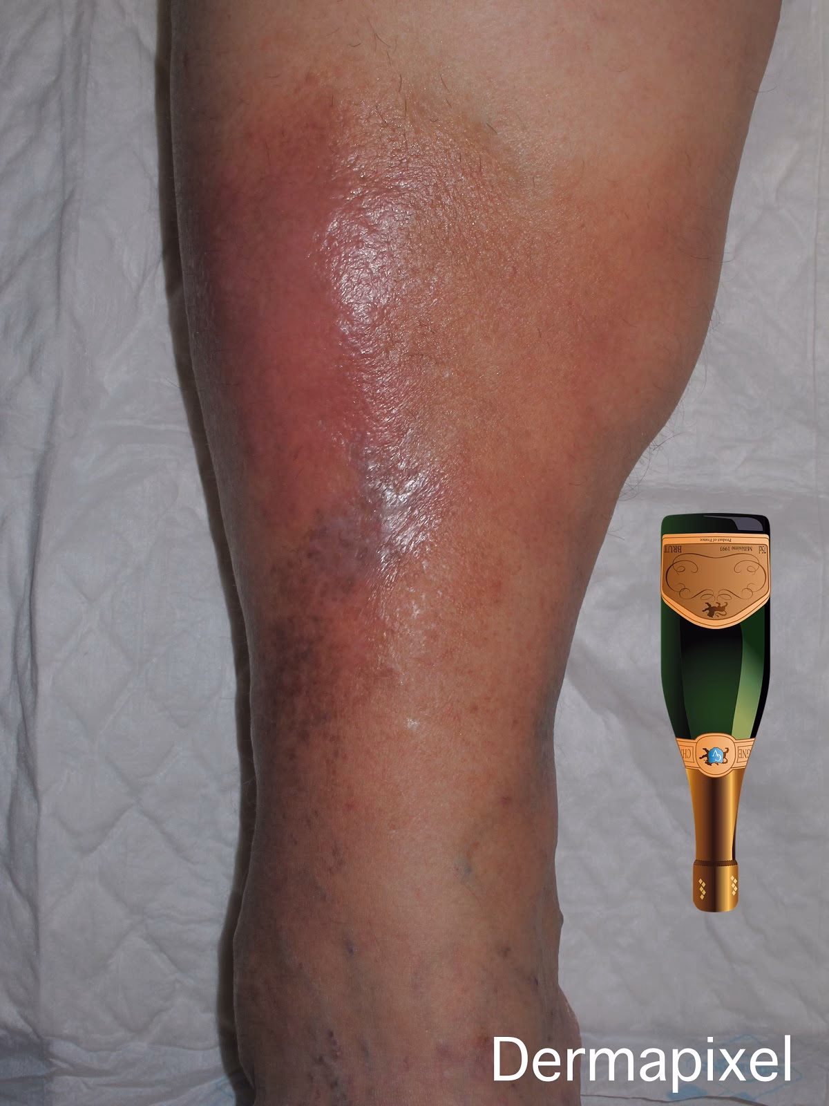 ¿Cómo se cura la lipodermatoesclerosis?