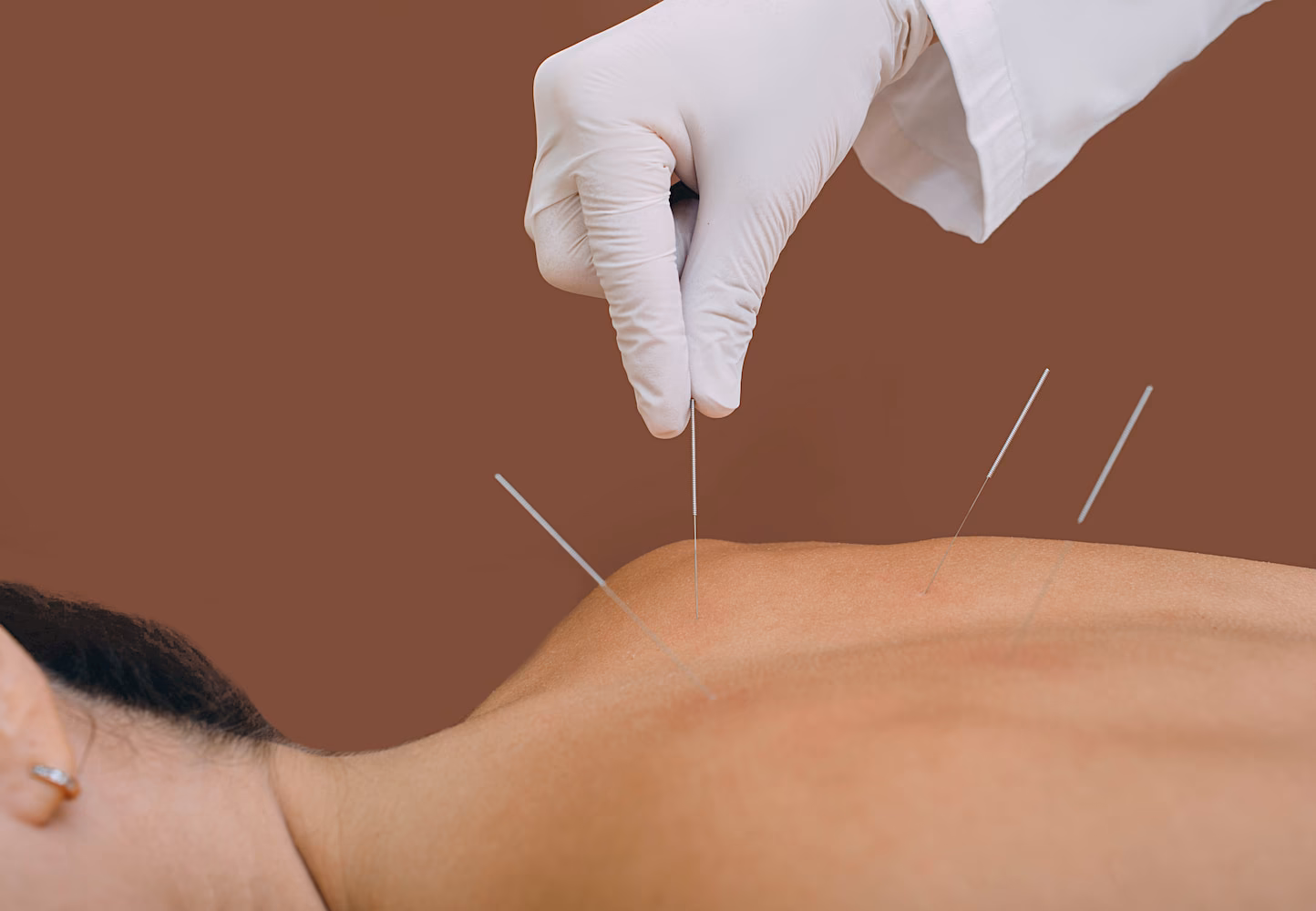 Where do acupuncturists make the most money?