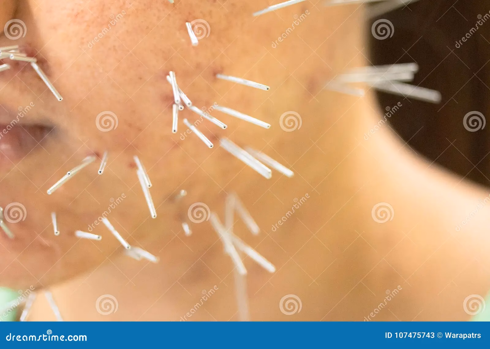 ¿Qué tratamientos existen para la melasma?