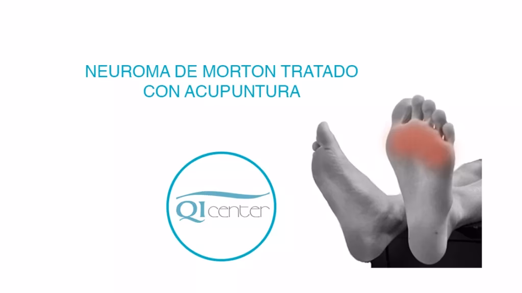 How do you shrink a neuroma naturally?