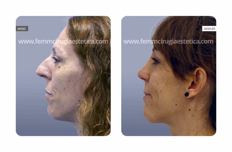 ¿Cuánto cuesta una cirugía para levantar la punta de la nariz?