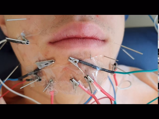 How do you fix paresthesia?