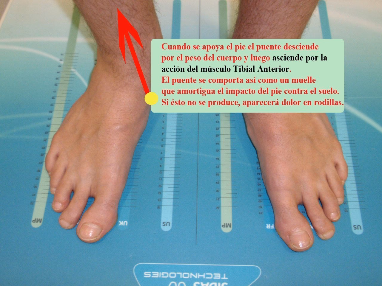 How do you fix anterior tibial tendonitis?
