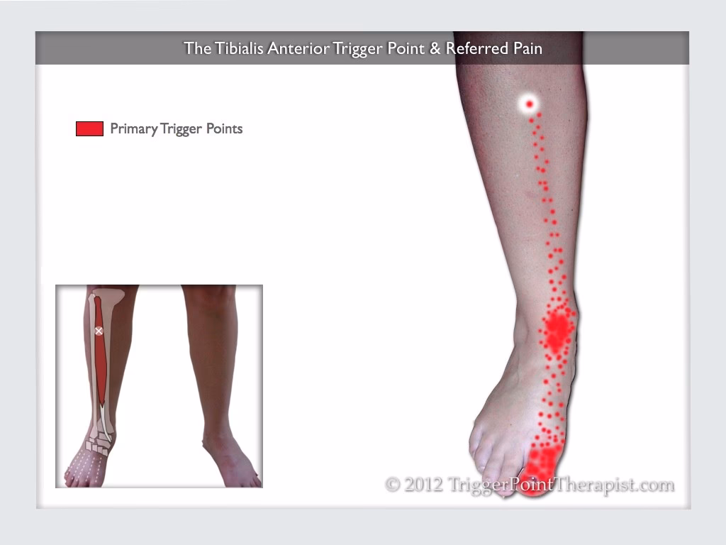 How long does it take for anterior tibial tendonitis to heal?