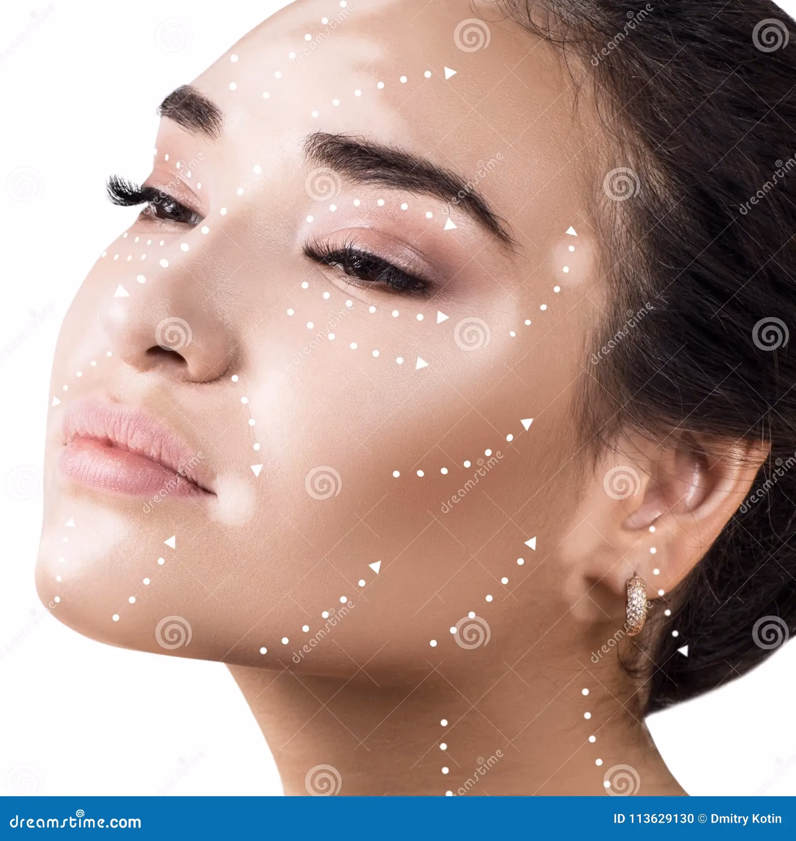 What is the treatment protocol for vitiligo?