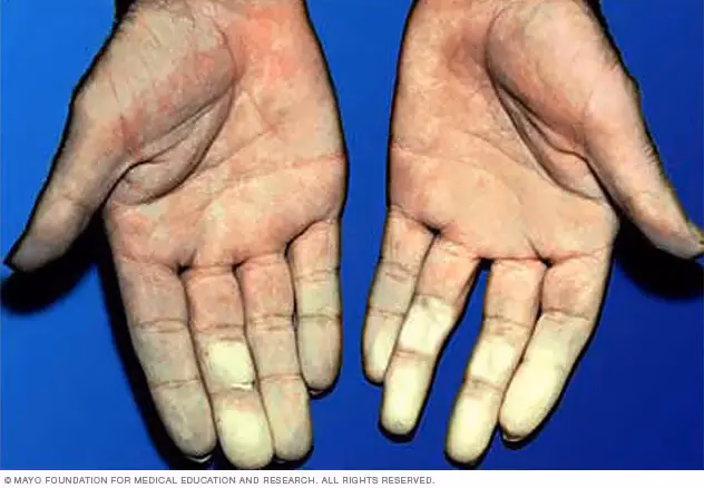 ¿Qué significa tener la punta de los dedos fría?