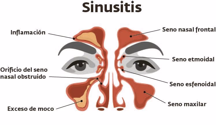 ¿Cómo desintoxicar mi cuerpo de una alergia?