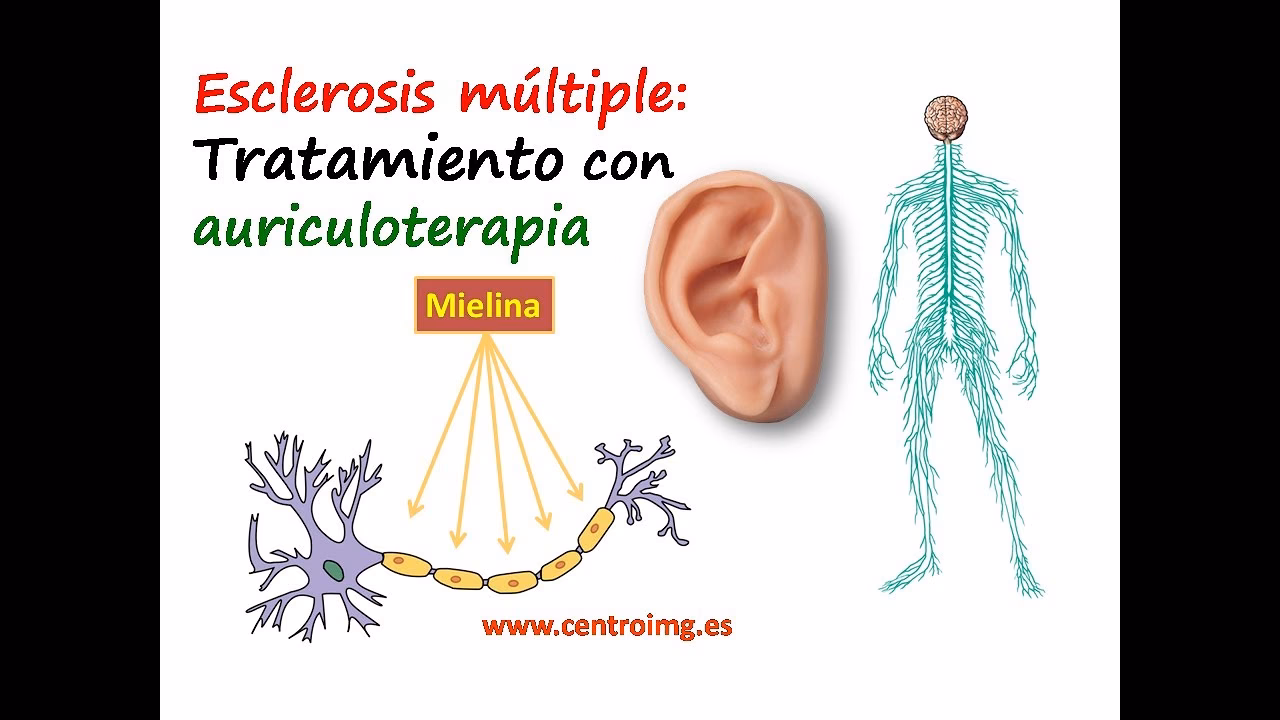 ¿Cuáles son los puntos de acupuntura para la esclerosis múltiple?