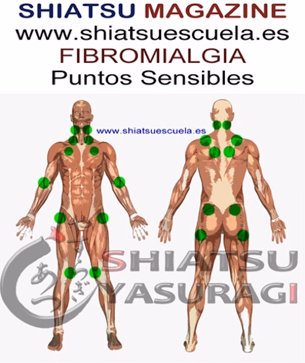 ¿Dónde están los 18 puntos sensibles de la fibromialgia?