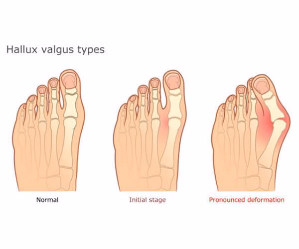 ¿Cómo se corrige el hallux valgus?