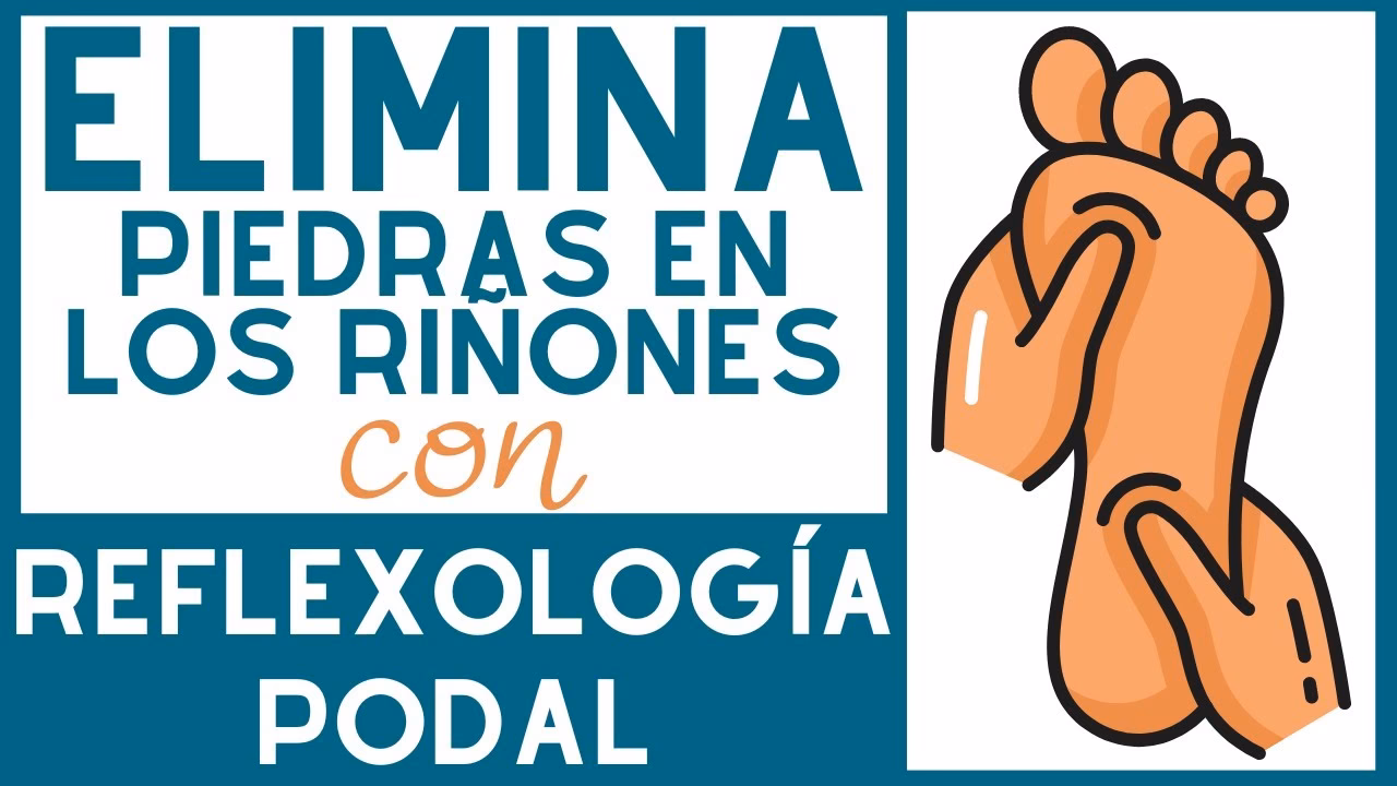 ¿Qué posición ayuda a expulsar un cálculo renal?