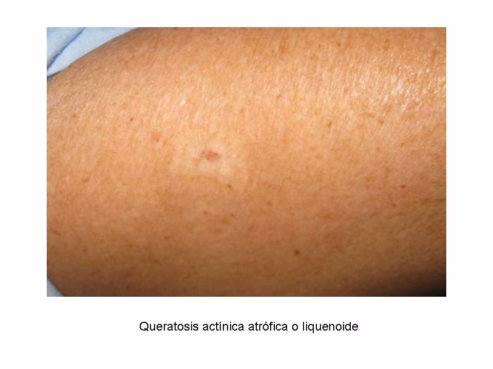 ¿Cómo eliminar la queratosis actínica?
