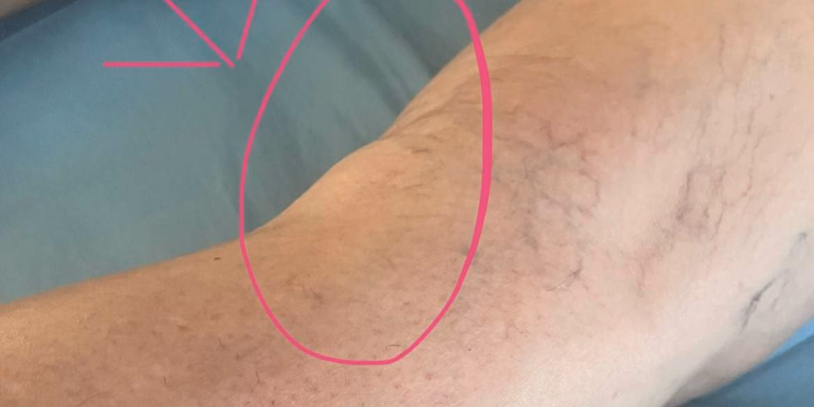 ¿Qué es bueno para desinflamar el quiste de Baker?