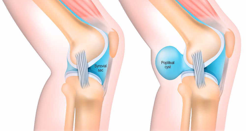 ¿Cómo eliminar el quiste de Baker de forma natural?