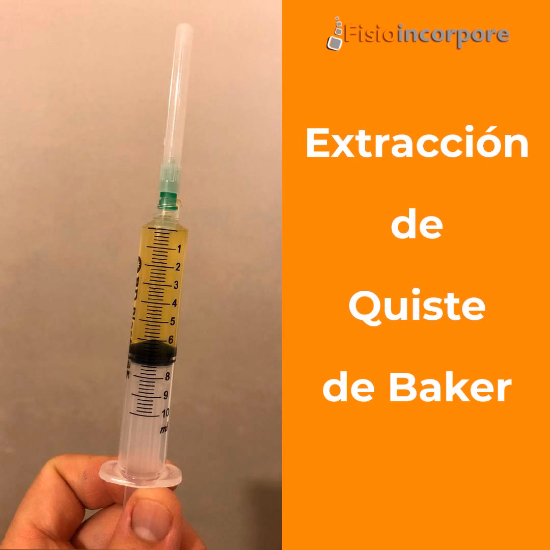¿La acupuntura ayuda con el quiste de Baker?