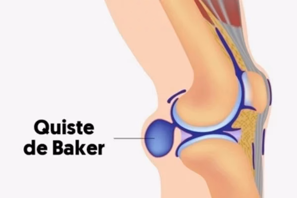 ¿Qué hace la acupuntura en la rodilla?