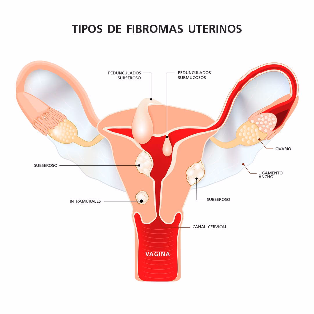 ¿Qué es un quiste subseroso?
