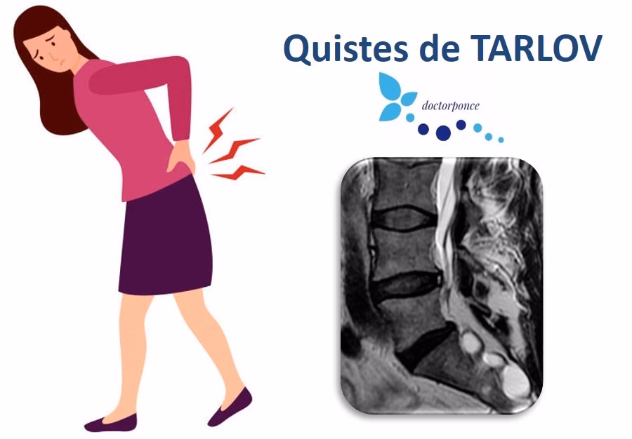 ¿Qué hacer para tratar los quistes de Tarlov?