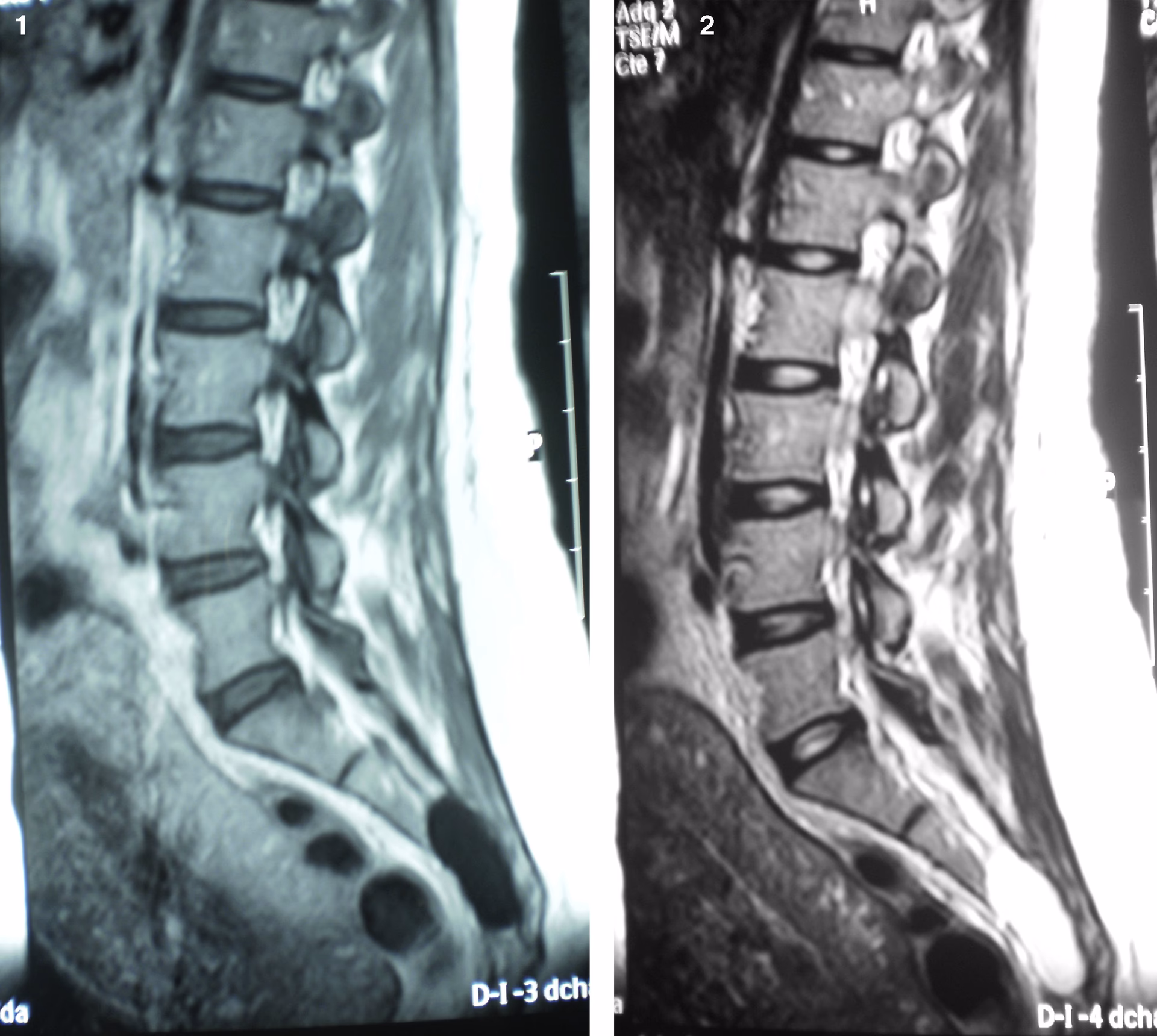 ¿Se puede hacer ejercicio con quistes de Tarlov?