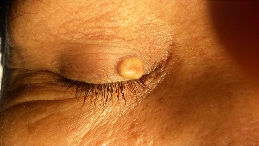 ¿Cómo eliminar un quiste en el párpado del ojo?