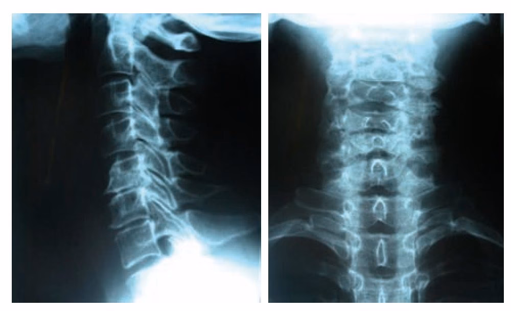 ¿Cómo tumbarse con rectificación cervical?