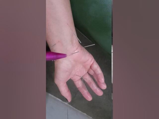 O que fazer para desinflamar o nervo do túnel do carpo?