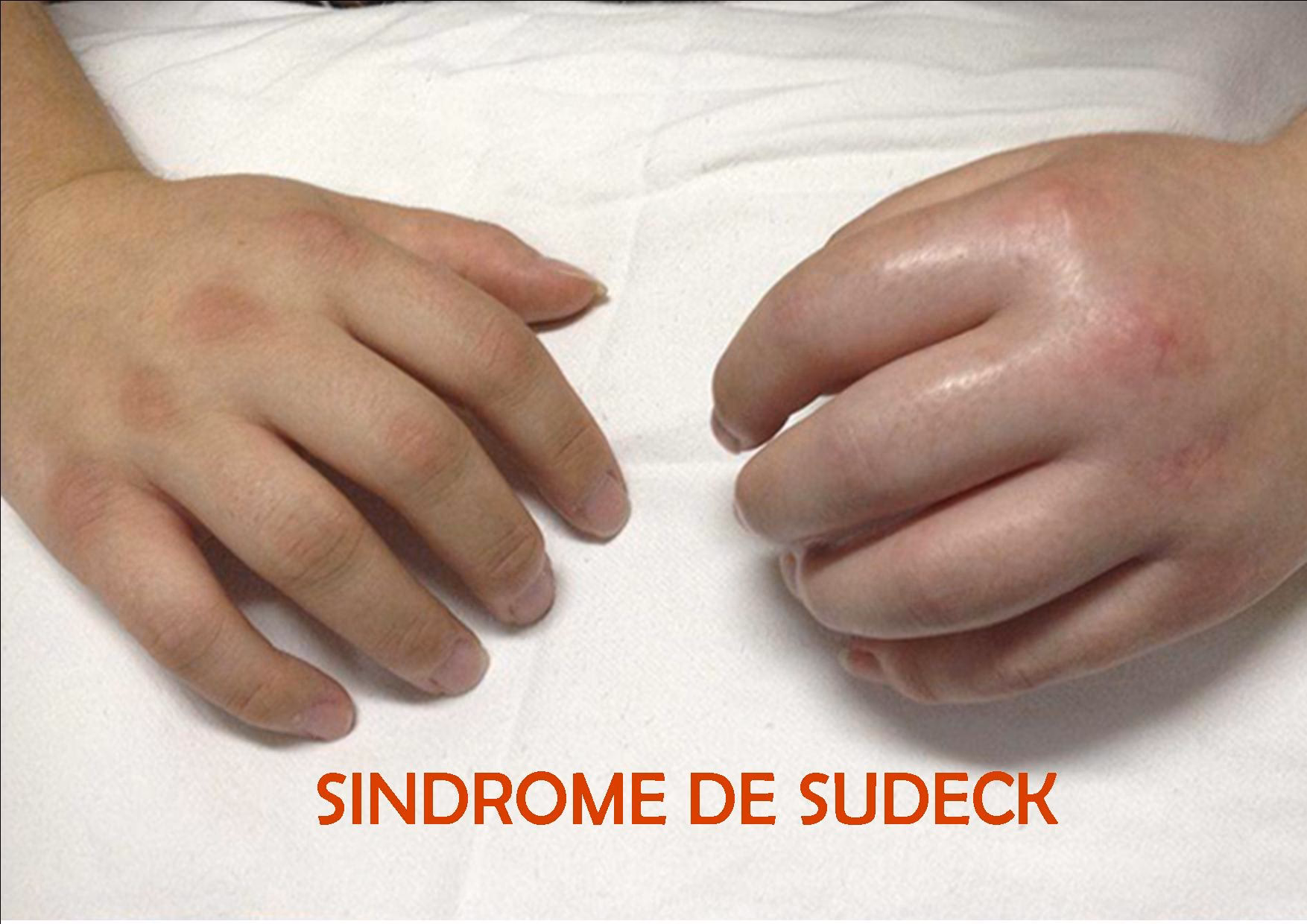 What is a Sudeck dystrophy?
