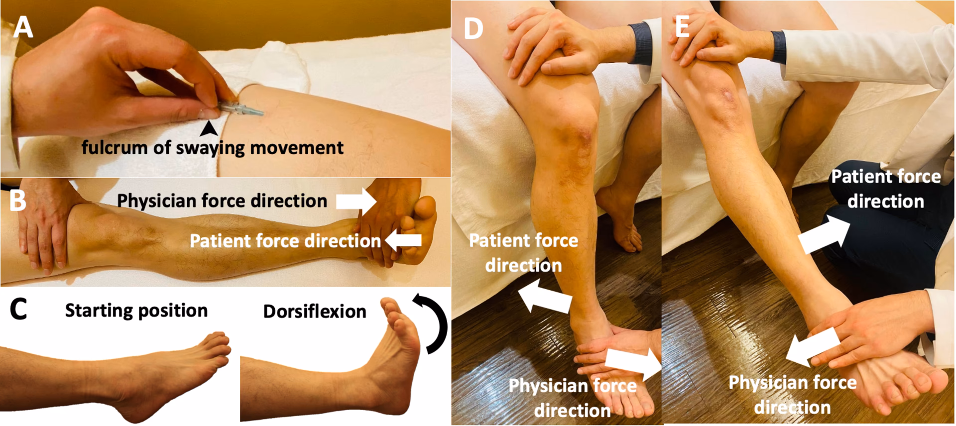 ¿Qué es la terapia de agujas secas?