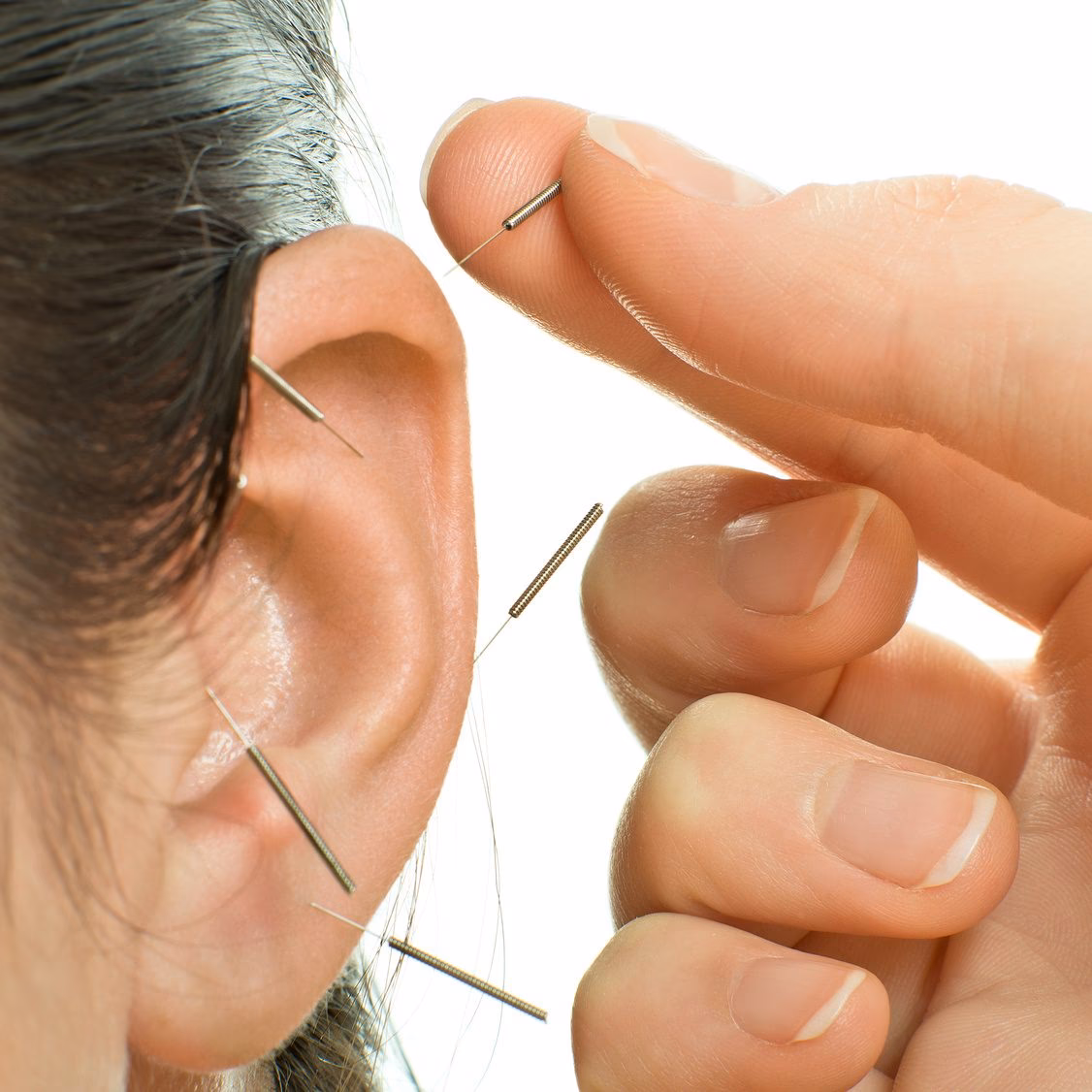 ¿Cuáles son los 5 puntos de la acupuntura auricular?
