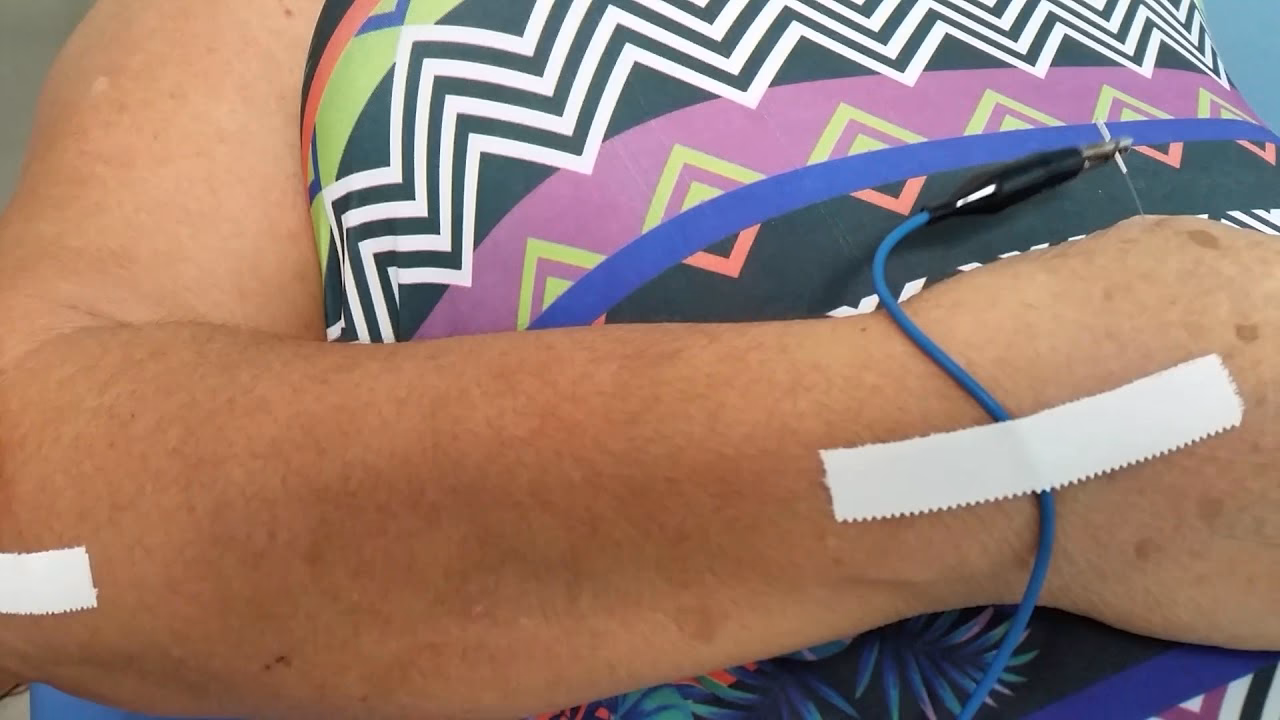 What is the use of TENS acupuncture?