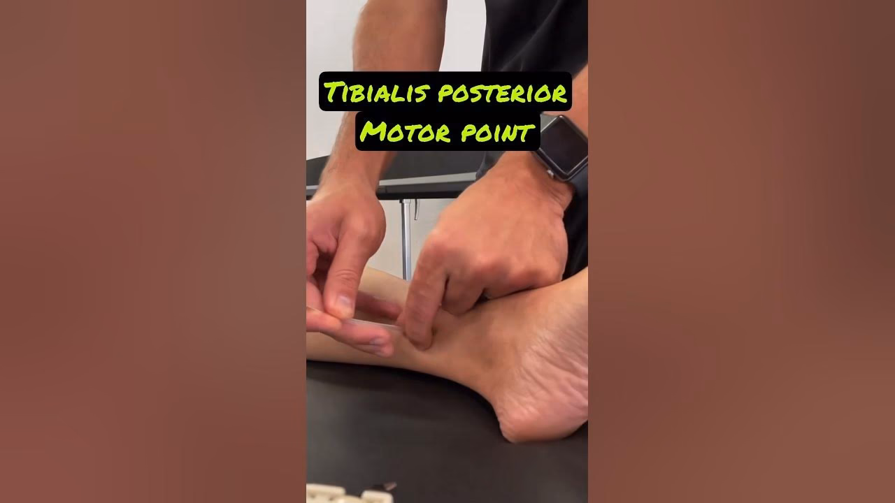Can you walk with a torn posterior tibialis tendon?