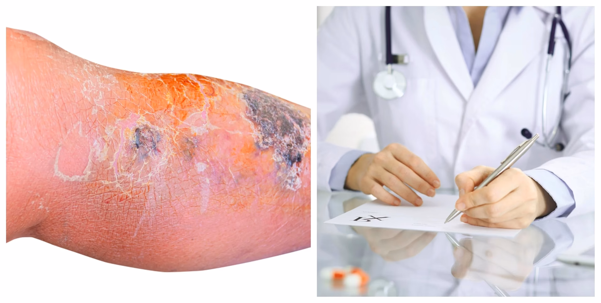 ¿Cómo se llama la pomada para la erisipela?