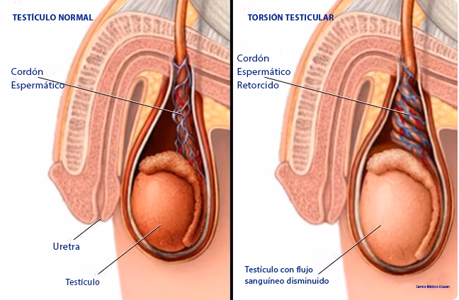 ¿Cómo eliminar la torsión testicular?