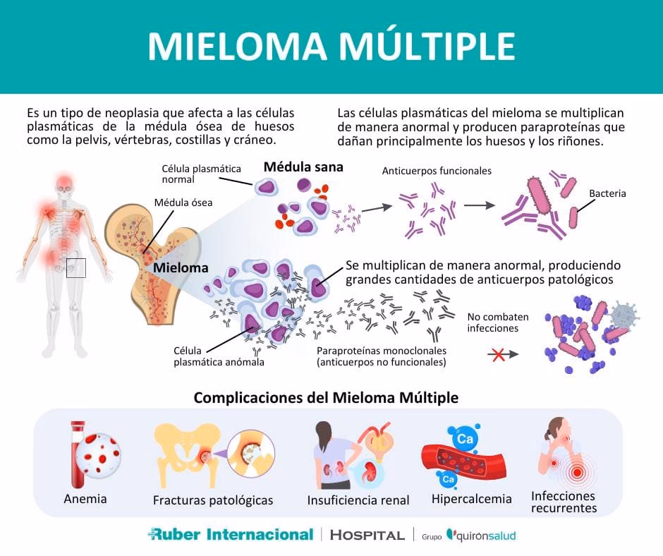 ¿Cuál es el mejor tratamiento para el mieloma múltiple?