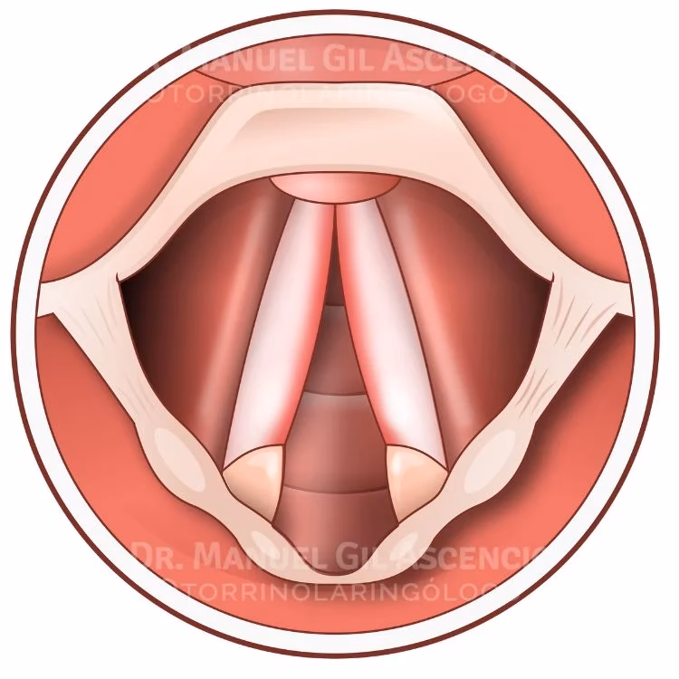 ¿Cuánto tiempo tardan en desinflamar las cuerdas vocales?