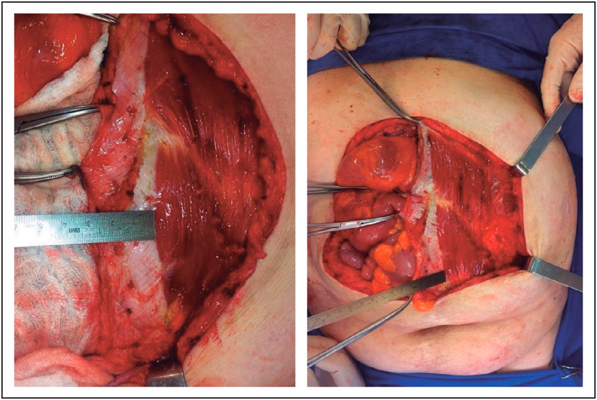 ¿Cómo se repara una eventración?