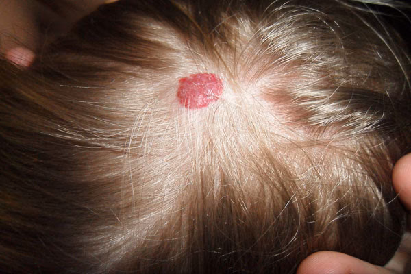 ¿Cuál es el tratamiento para un hemangioma en el cuero cabelludo?